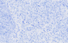 Load image into Gallery viewer, Canine melanoma stained with An Automated Hematoxylin for 1 minute; 40X