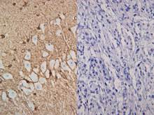 Load image into Gallery viewer, Feline brain and Canine melanocytoma stained with S100B

