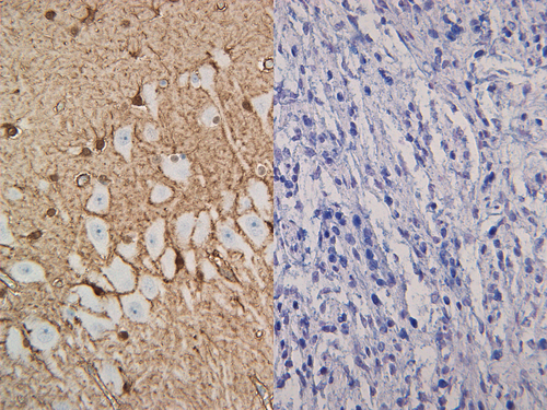 Feline brain and Canine melanocytoma stained with S100B