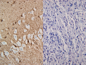 Feline brain and Canine melanocytoma stained with S100B