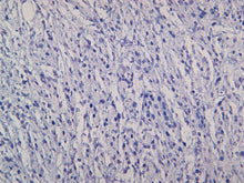Load image into Gallery viewer, Canine melanocytoma stained with S100B
