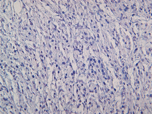 Canine melanocytoma stained with S100B