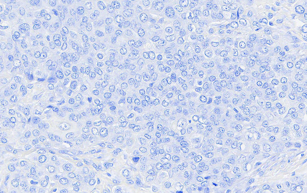  Canine melanoma stained with An Automated Hematoxylin for 1 minute with A Bluing Solution 10 seconds; 40X