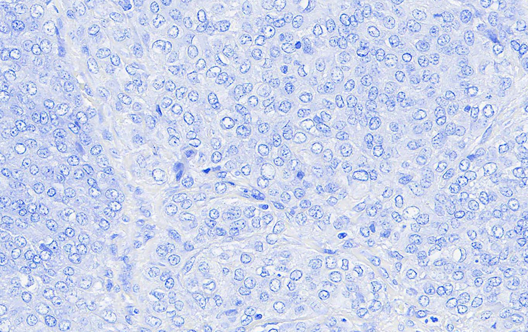  Canine melanoma stained with An Automated Hematoxylin for 1 minute; 40X