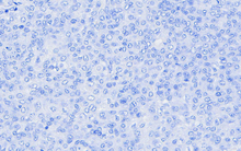 Load image into Gallery viewer,  Canine melanoma stained with An Automated Hematoxylin for 5 minute with A Bluing Solution 10 seconds; 40X
