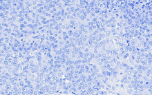 Load image into Gallery viewer,  Canine melanoma stained with An Automated Hematoxylin for 5 minute; 40X
